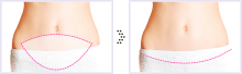 tummy tuck