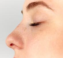 Enhance your facial balance with expert rhinoplasty in Islamabad. Reshape your nose to improve function for a more harmonious look.