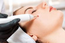 mole removal in Dubai