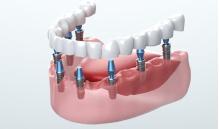 Teeth whitening Mississauga treatment at Revive Dental clinic