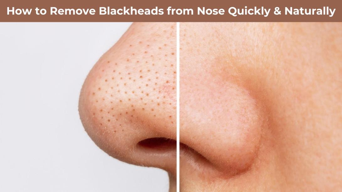 How to Remove Blackheads from Nose Naturally Quickly Permanently & Instantly