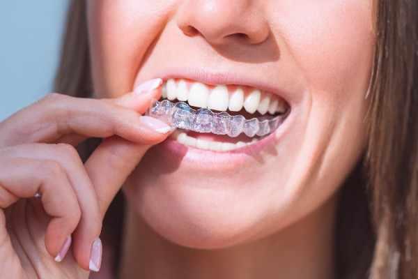 invisalign