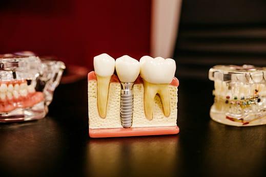 Teeth Whitening & Dental Implants