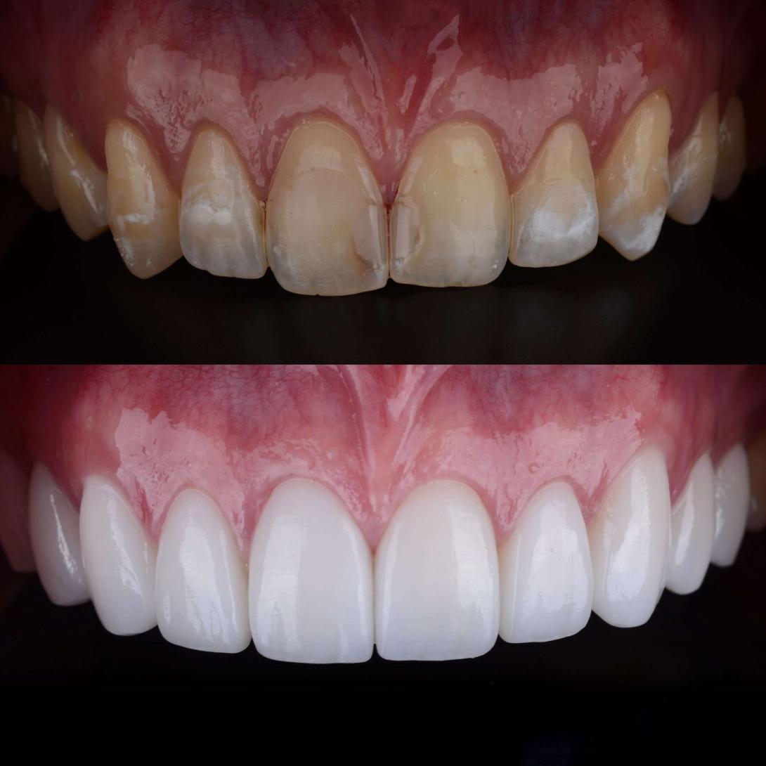 teeth whitening Hastings