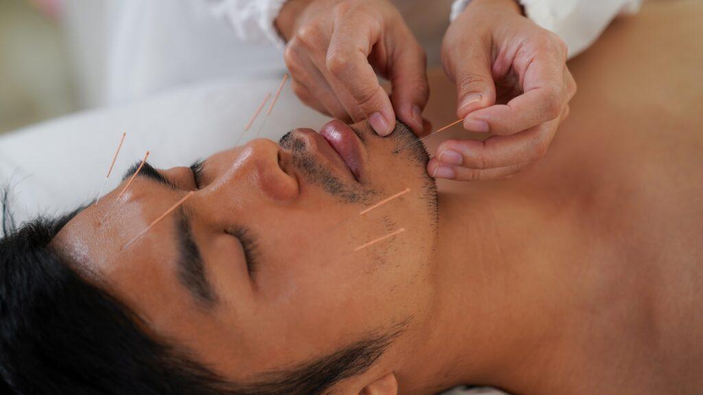 Facial Acupuncture Philadelphia
