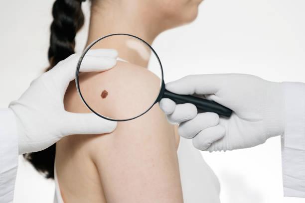 Mole removal in Dubai