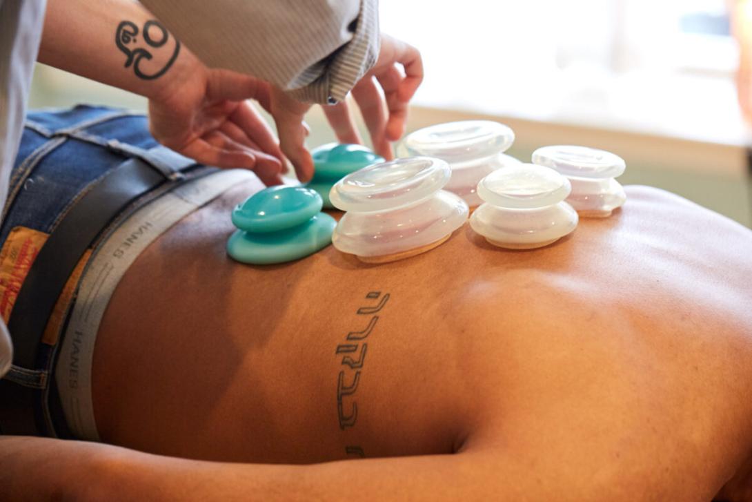 Cupping Therapy Philadelphia