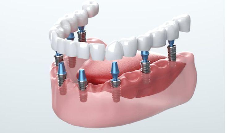 Revive Dental Mississauga offers implants, teeth cleaning, whitening & emergency dental care. Visit the best dentist in Mississauga today.